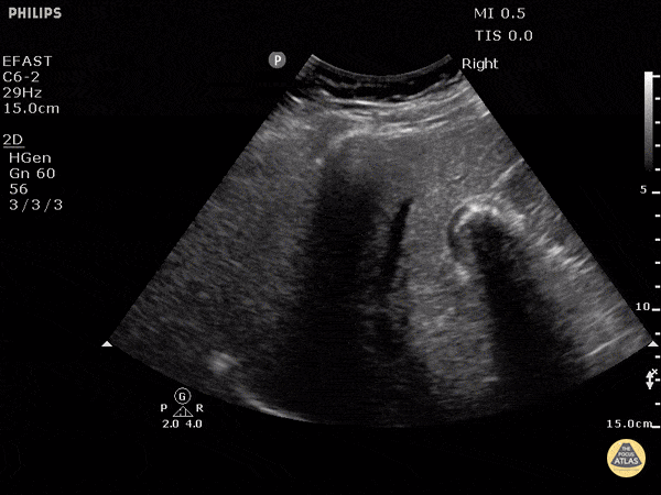 Chronic Cholecystitis Ultrasound Wes Sign