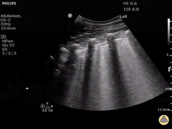 B-Lines - Pulmonary Edema