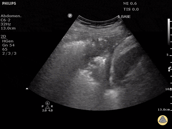 Compression Atelectasis