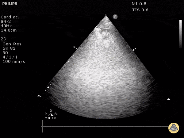 Pulmonary Embolism (Sector Probe)