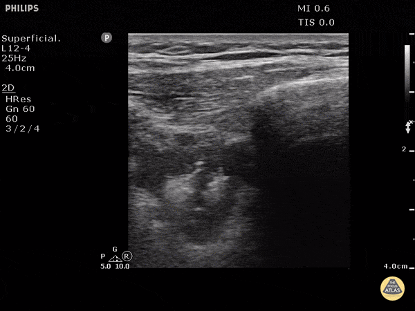 Pulmonary Embolism (B mode)