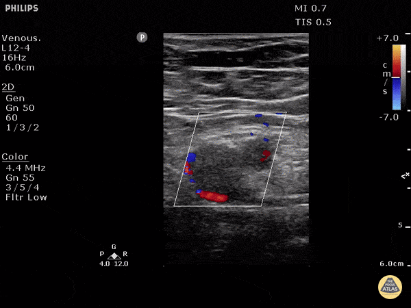 DVT of Left Common Femoral Vein