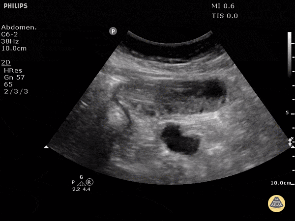 Small Bowel Obstruction
