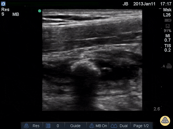 Enlarged Appendix with Appendicolith