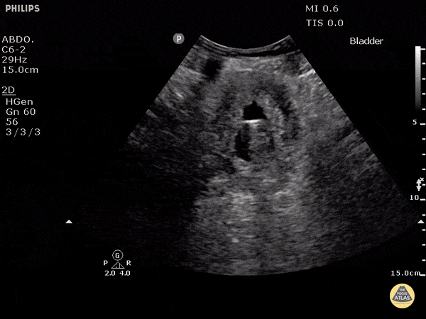 Bladder Contracted with Indwelling Catheter