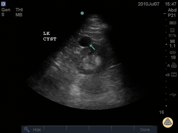 Left Renal Cyst