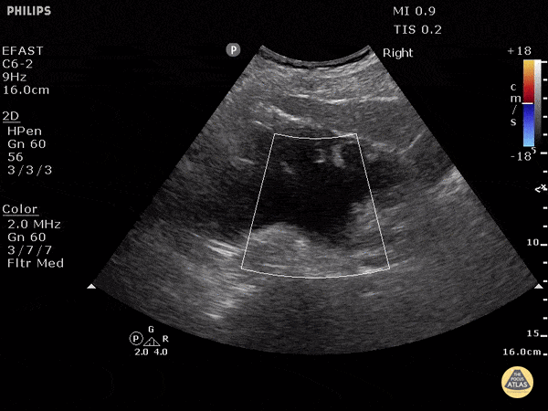 Severe Hydronephrosis