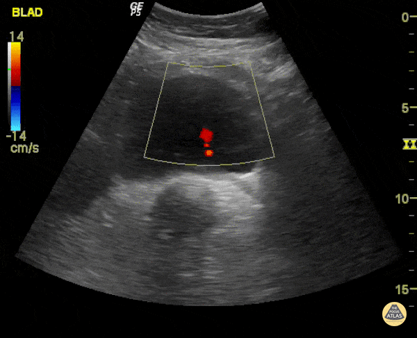 Ureteric Jet