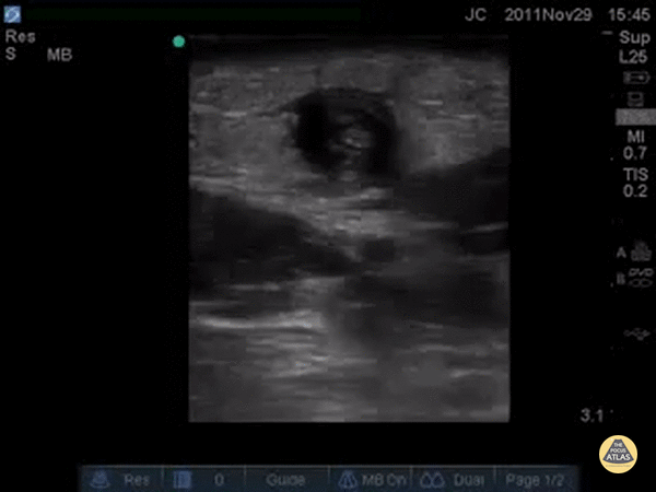Cephalic Vein Thrombophlebitis