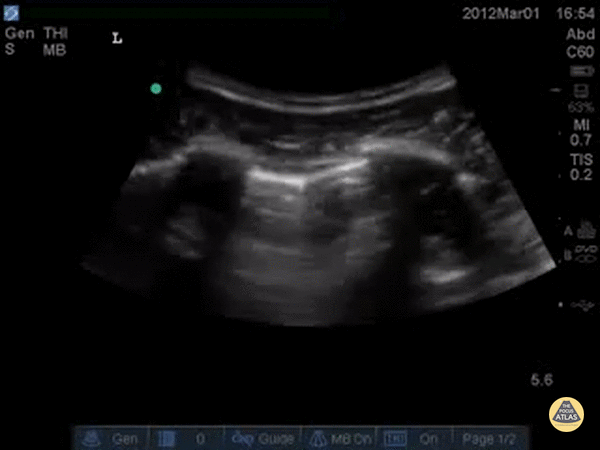Pneumothorax Lung Point