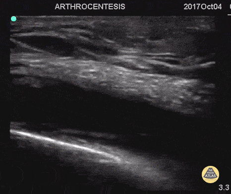 Arthrocentesis and Joint Injection
