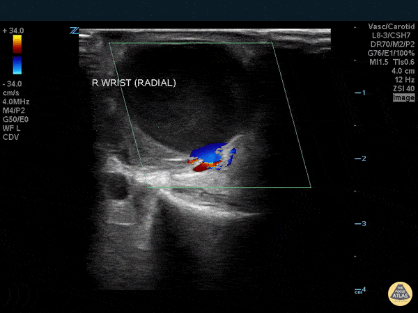 Pseudoaneurysm - Radial Artery