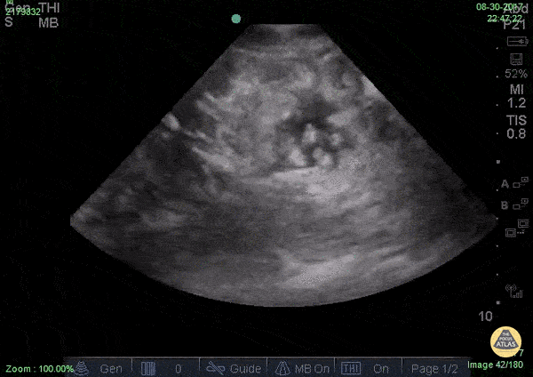 Ascites... hello?