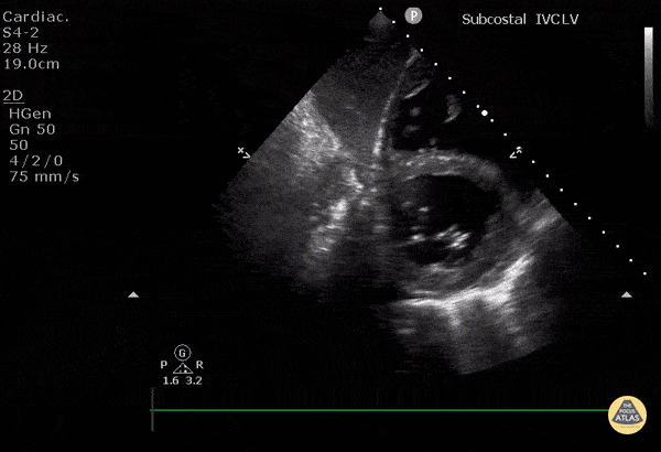 Subcostal Short Axis