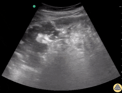 Perforated Appendicitis