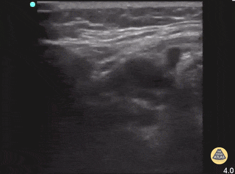 Sialadenitis (Postoperative)