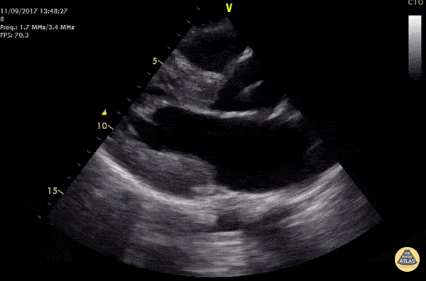 Hypertrophic Obstructive Cardiomyopathy