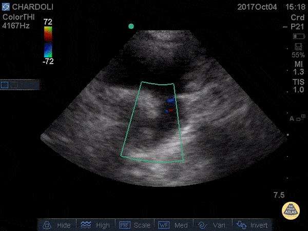 Ductus Arteriosus (Patent)