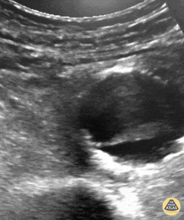 Pulsating Aortic Aneurysm