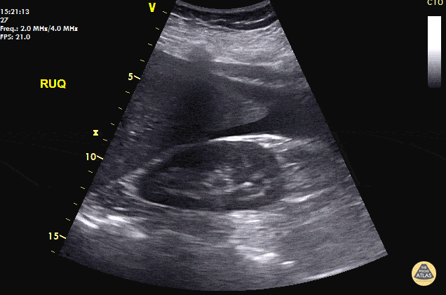 Ddxof Ultrasound In Ectopic Pregnancy — Tpa 