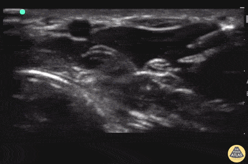 Median Nerve Block