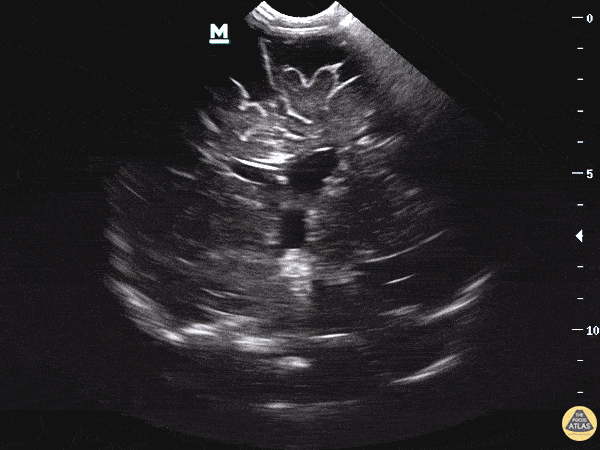 Obstructive Hydrocephalus