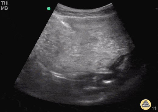 Gastric Volvulus