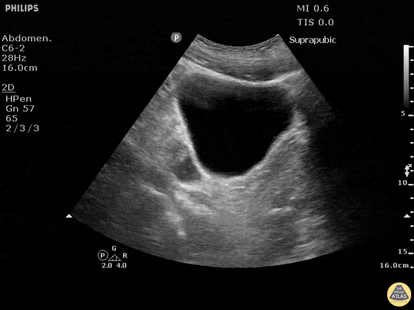 Positive FAST - Pelvis Transverse