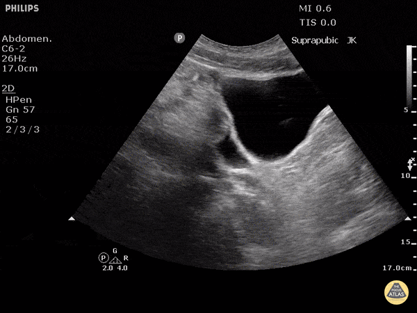 Positive FAST - Pelvis - Sagittal