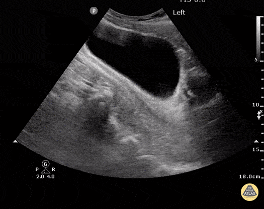 Normal FAST - Pelvis - Sagittal