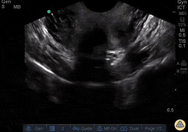 Bicornuate Uterus with IUP