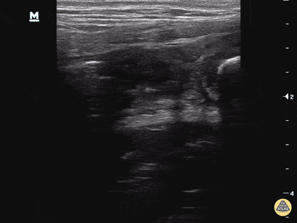 Appendicitis with two fecaliths