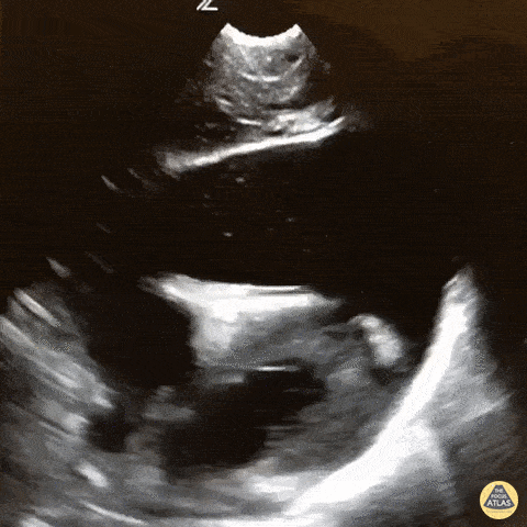 Acute Traumatic Cardiac Tamponade