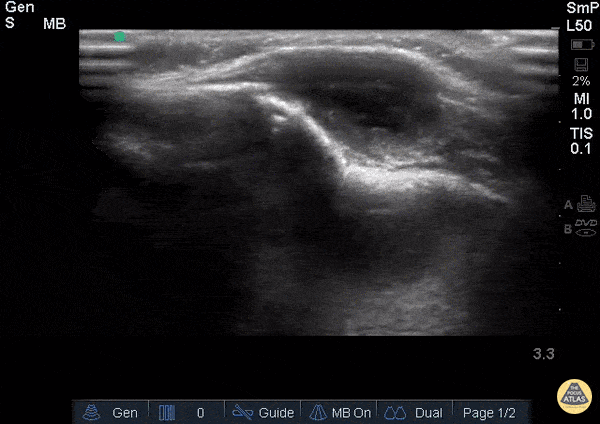 Facial Tumor