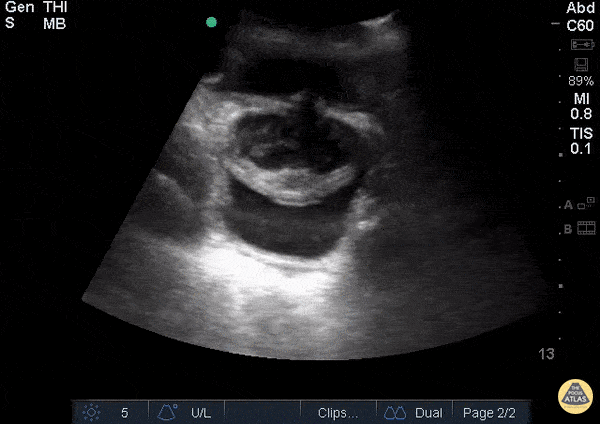Ureterocele