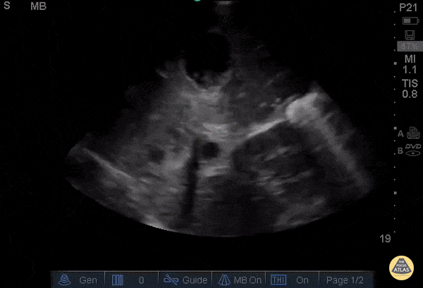 Hepatic Lesions (Incidental)