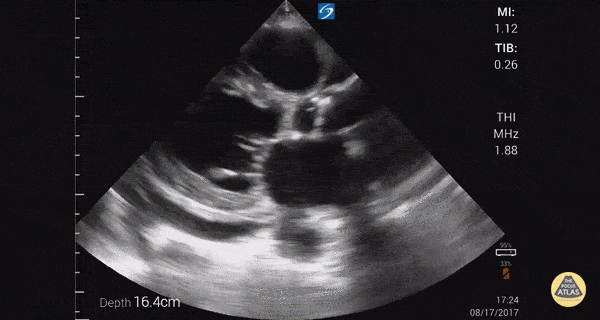 Reduced Ejection Fraction (Parasternal Long-Axis View)