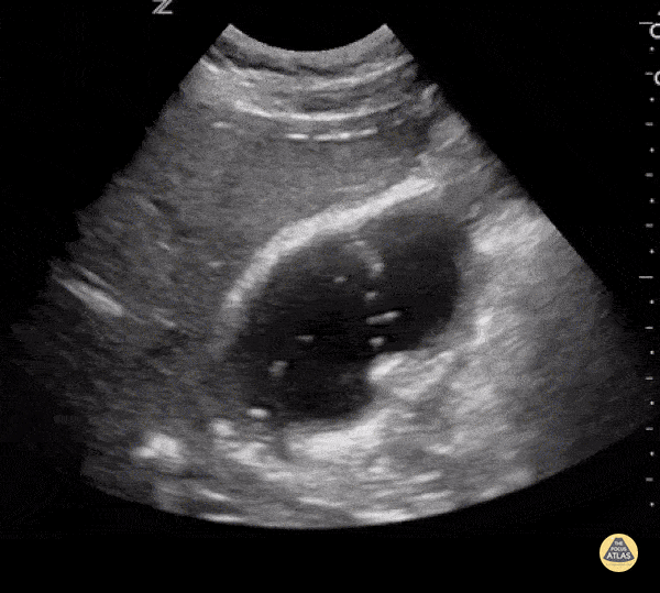 Duodeno-Biliary Fistula