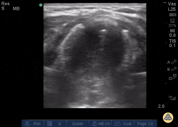 Tracheal Stenosis