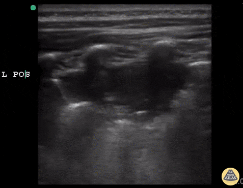 Acute Chest Syndrome
