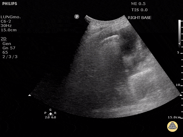 B-lines and Effusion