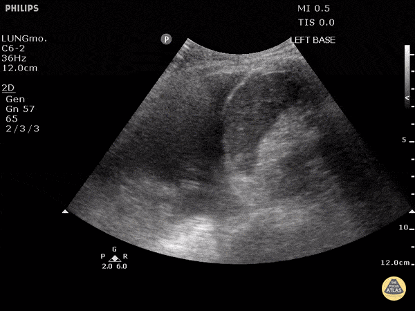 Pulmonary — TPA