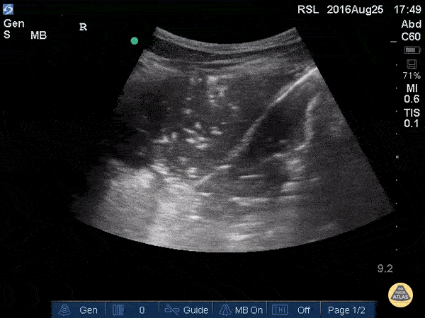 Lung Consolidation with Mirror Artifact