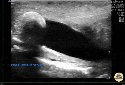 Penile Calculus.gif