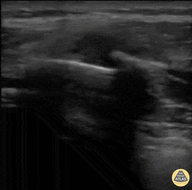 Rib Fracture
