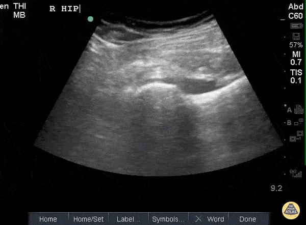 Hip Effusion