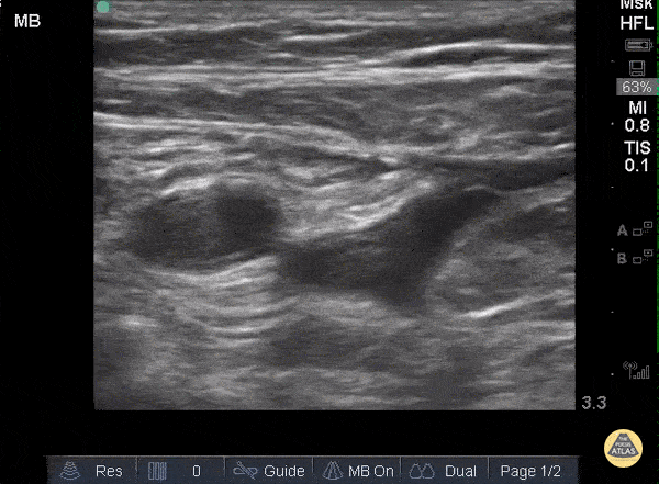 DVT - Common Femoral