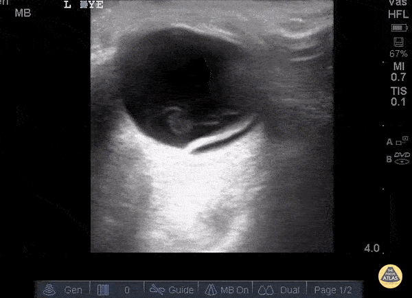 Retinal Detachment