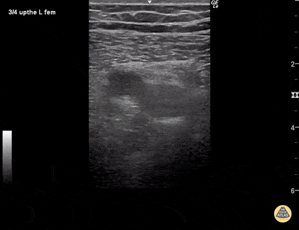 DVT - Superficial Femoral Vein