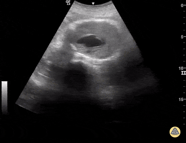 Abdominal Aortic Aneurysm